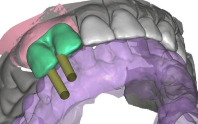 Rehabilitación combinada con implantes atornillados, metal cerámica y jacket con Estudio Estético via INTERNET