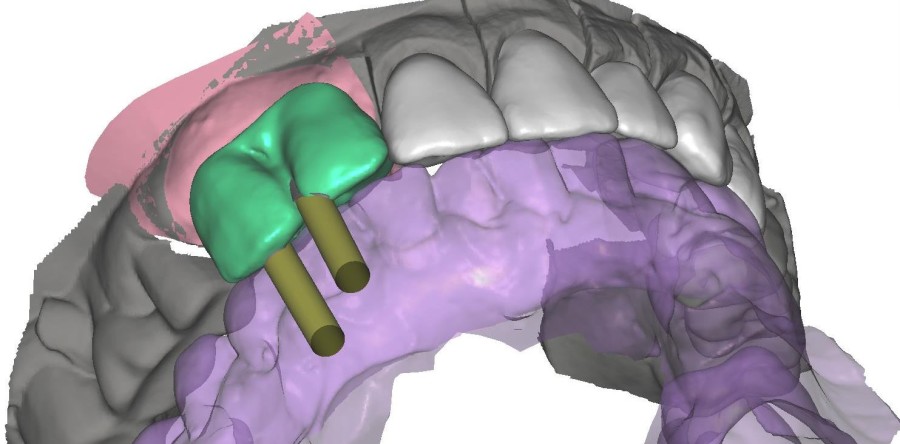 Rehabilitación combinada con implantes atornillados, metal cerámica y jacket con Estudio Estético via INTERNET