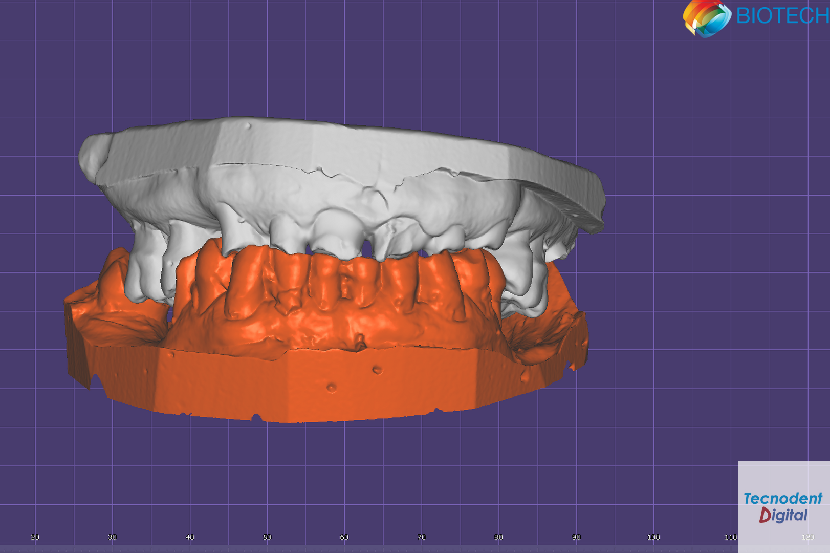 Estudio Estético Exocad Diseño Dental 3D Modelos Mock Up
