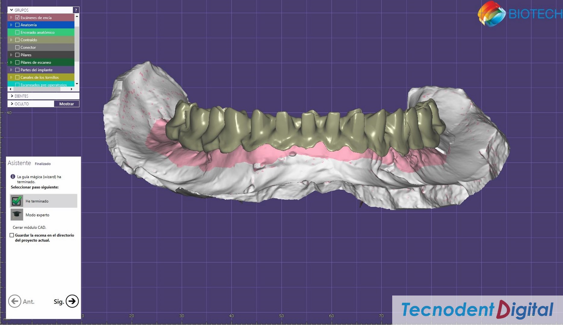 Rehabilitacion sobre implantes Exocad thimble coronas dientes a tope