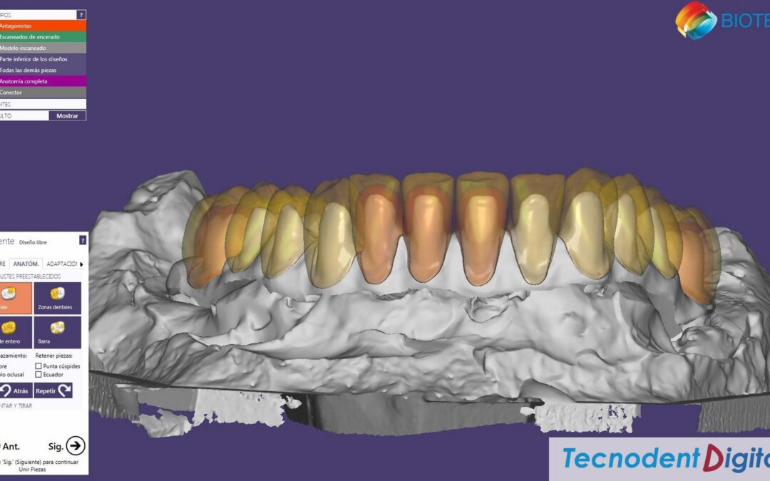 Diseño Rehabilitacion implantes Exocad thimble HIPC Bredent