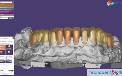 Rehabilitacion sobre Implantes 2