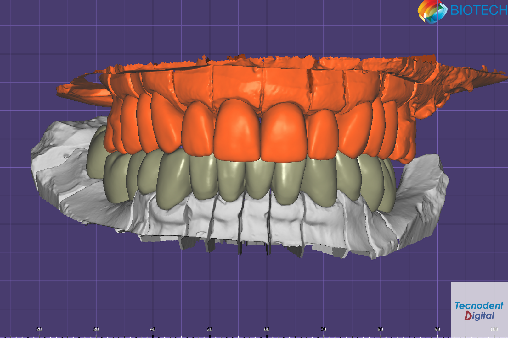 Estudio Estético Exocad Diseño Dental 3D Modelos Mock Up
