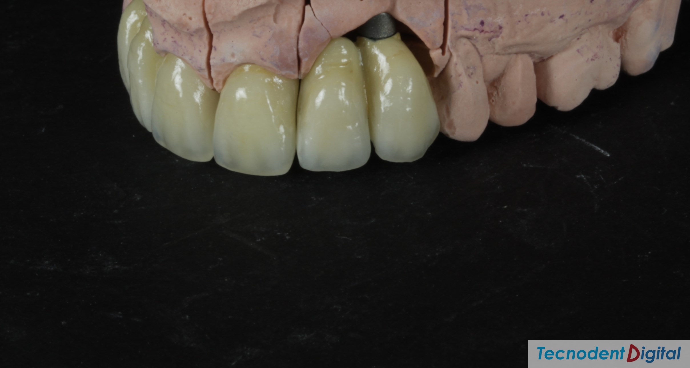 Implantes metal-ceramica estetica dental