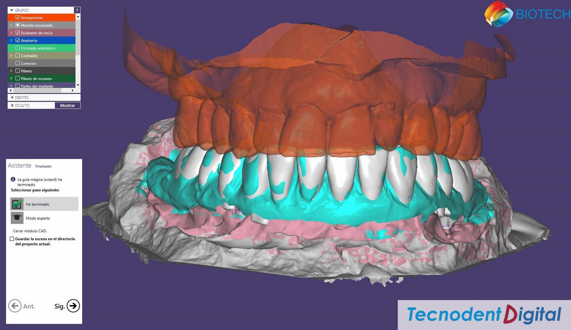 Exocad diseño 3D CAD CAM