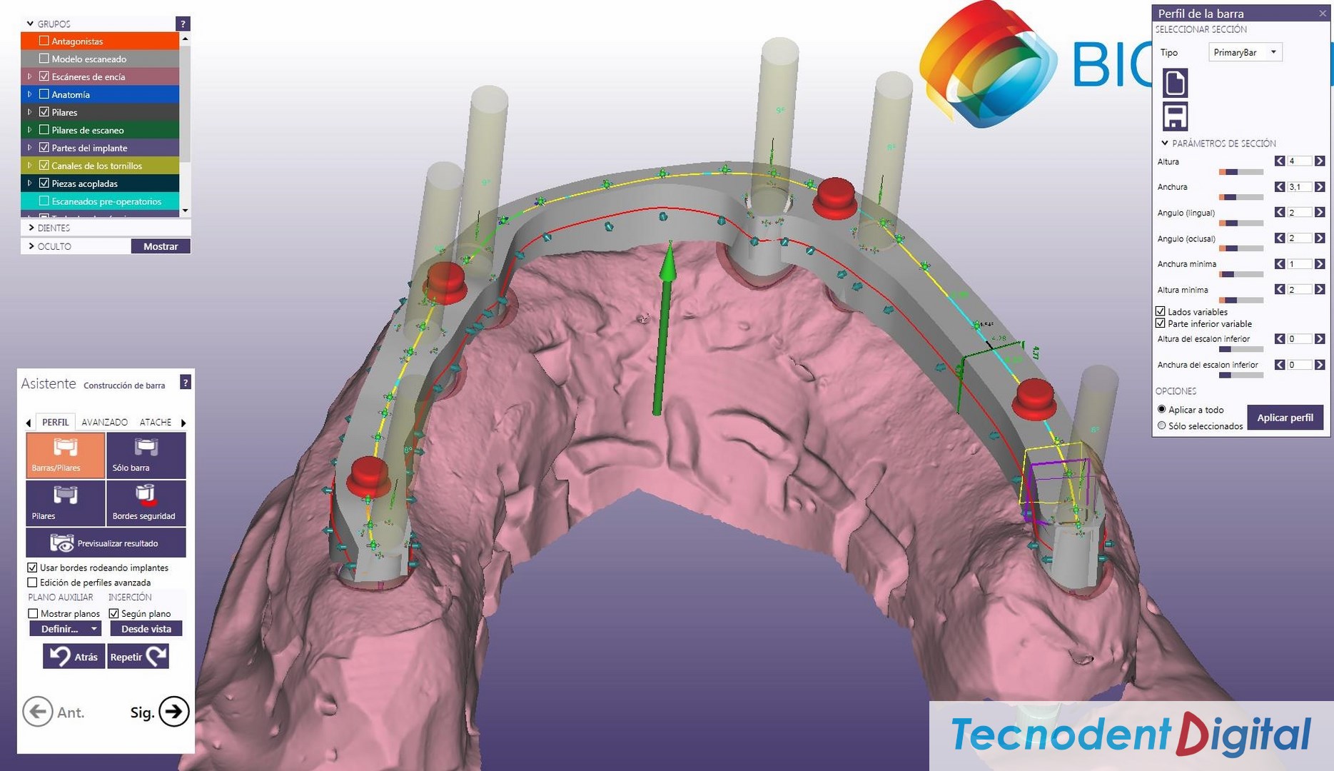 Implantes Barra Anclaje Diseño 3D Exocad