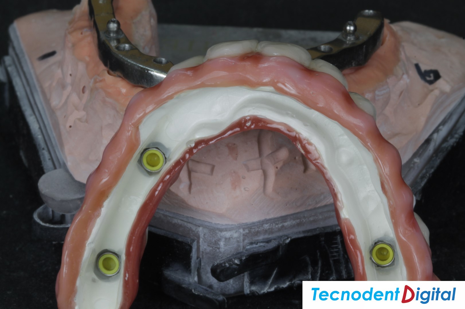 Implantes Barra Anclaje Diseño 3D Exocad sobredentadura