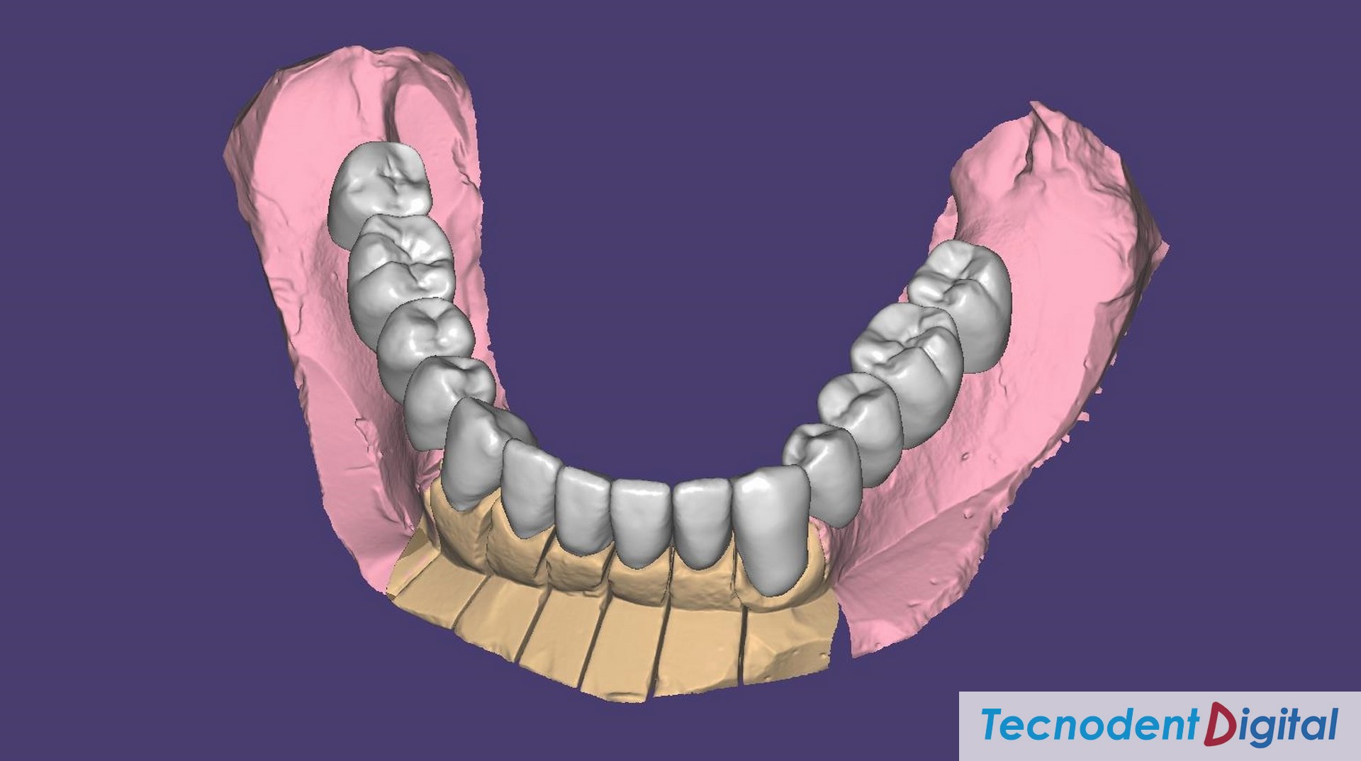 Coronas-de-zirconio-implantes-metal-ceramica-Rehabilitacion-oral-Laboratorio-Gandia