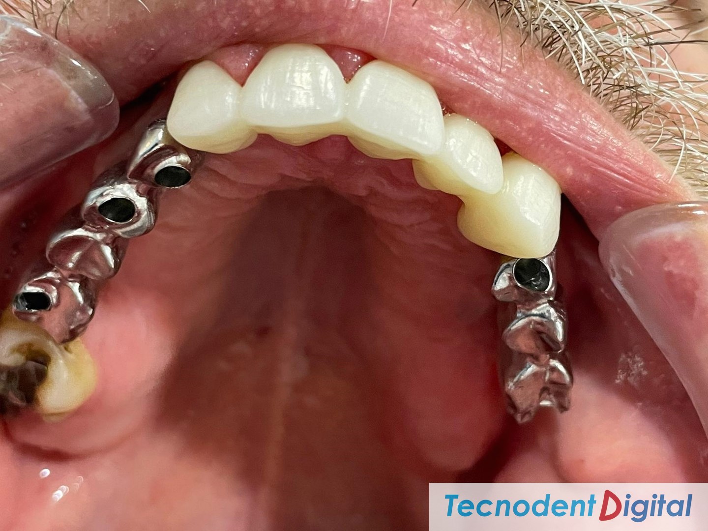 Coronas-de-zirconio-implantes-metal-ceramica-Rehabilitacion-oral-Laboratorio-Gandia