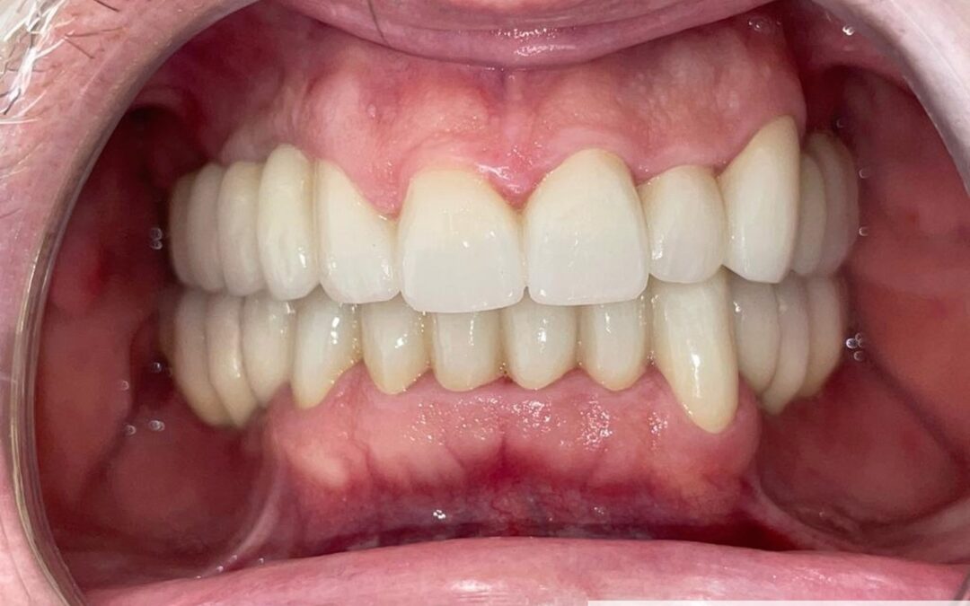 Coronas-de-zirconio-implantes-metal-ceramica-Rehabilitacion-oral-Laboratorio-Gandia