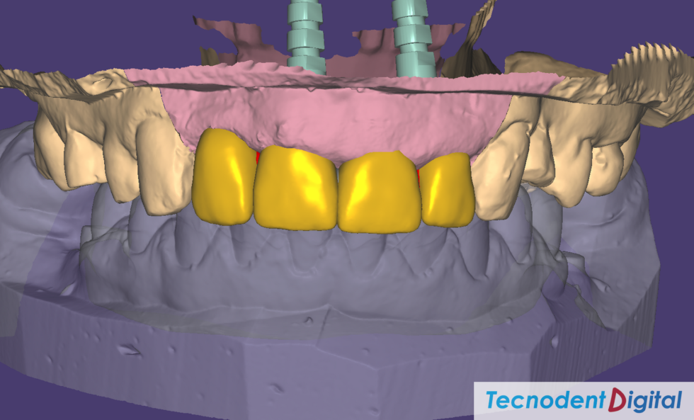 Zirconia Fused to Metal. Laboratorio Dental Gandia. Centro de Fresado. Odontologia Estetica.