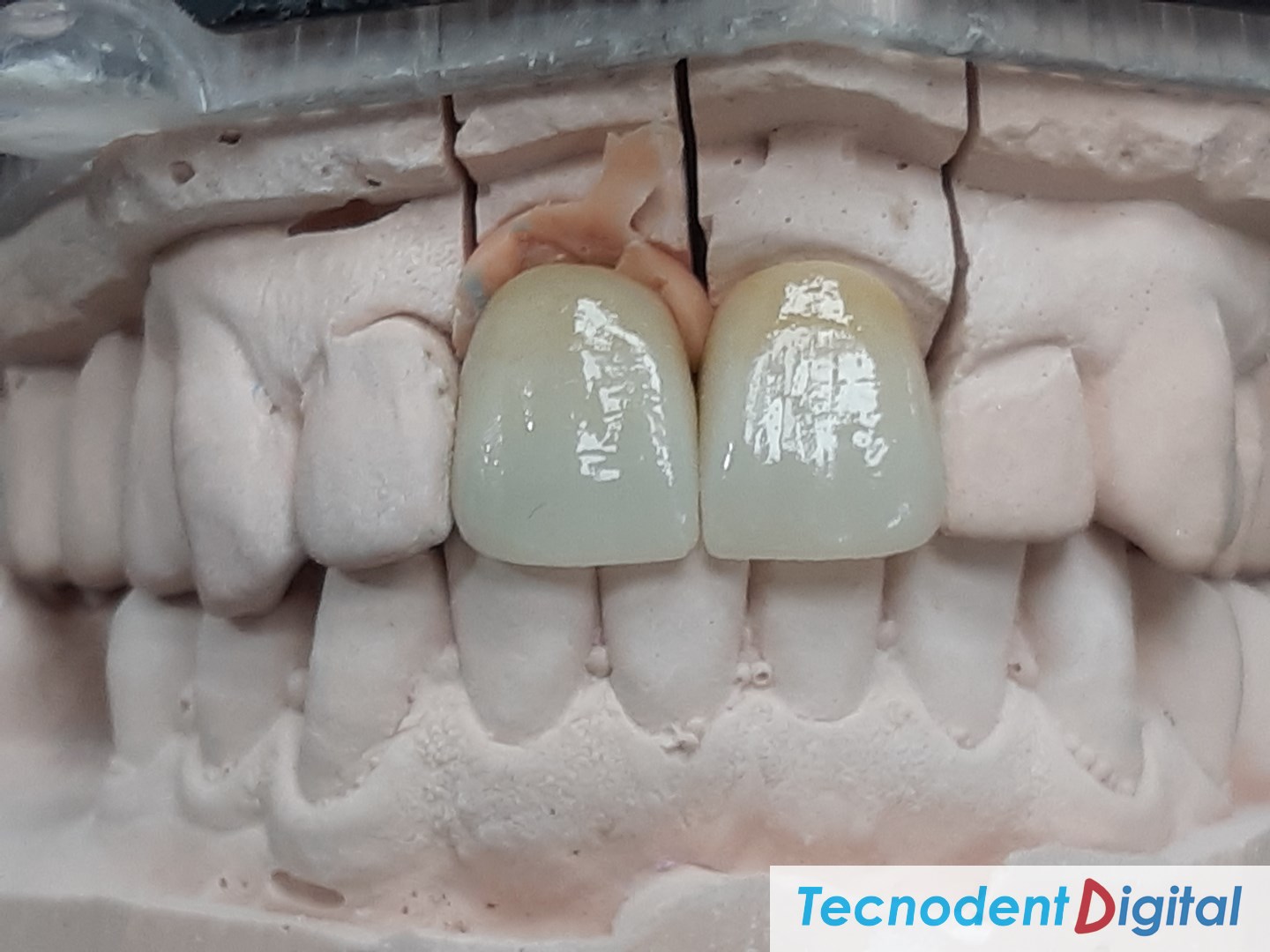 ZFM-Zirconia-Fused-to-Metal-Laboratorio-DentalGandia-Odontologia-Estetica-Centro-de-Fresado