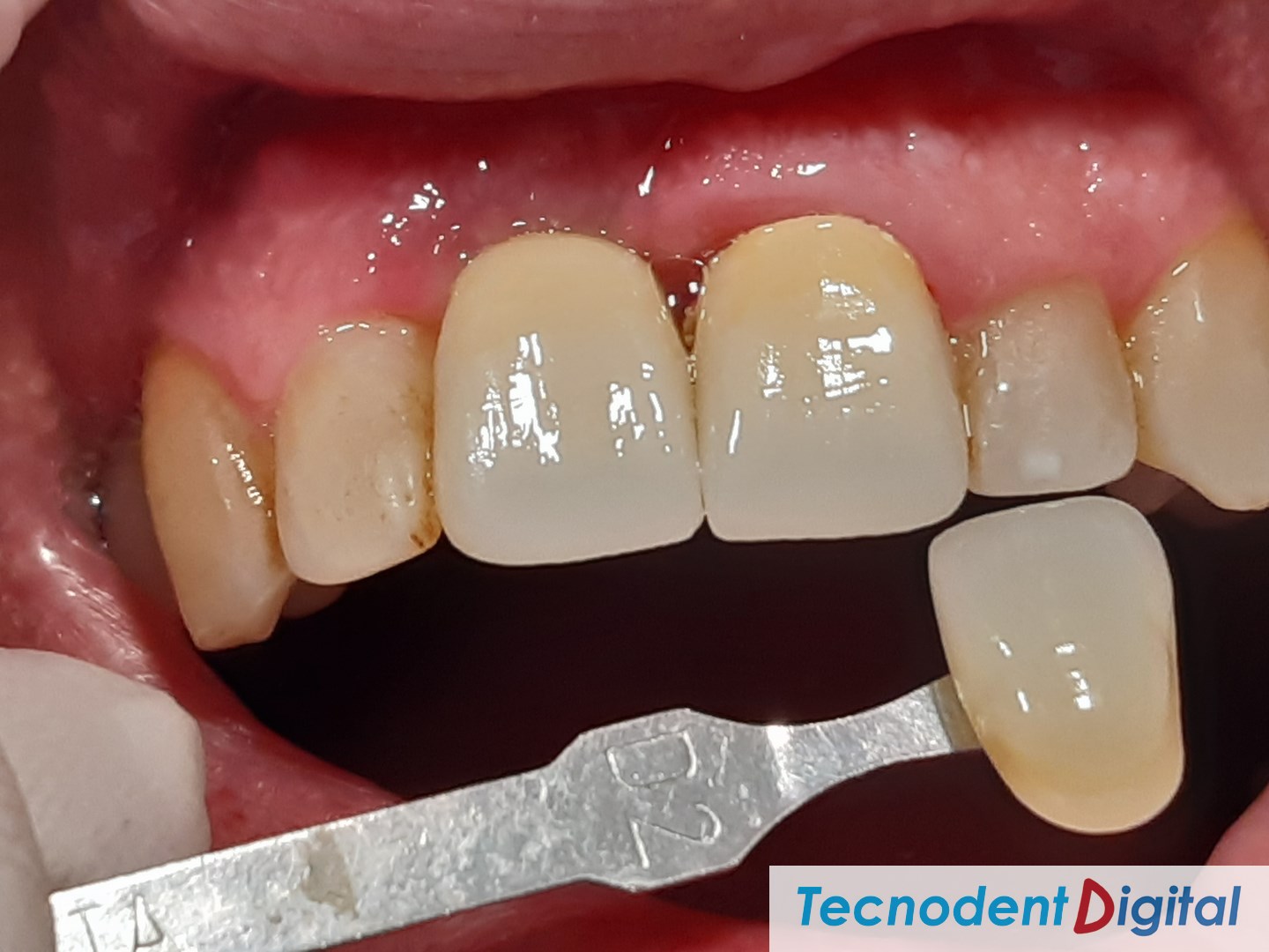 ZFM-Zirconia-Fused-to-Metal-Laboratorio-DentalGandia-Odontologia-Estetica-Centro-de-Fresado
