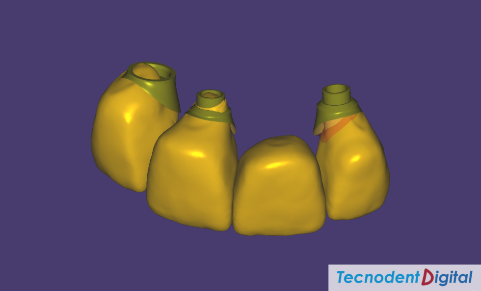 Zirconia Fused to Metal. Laboratorio Dental Gandia. Centro de Fresado. Odontologia Estetica.