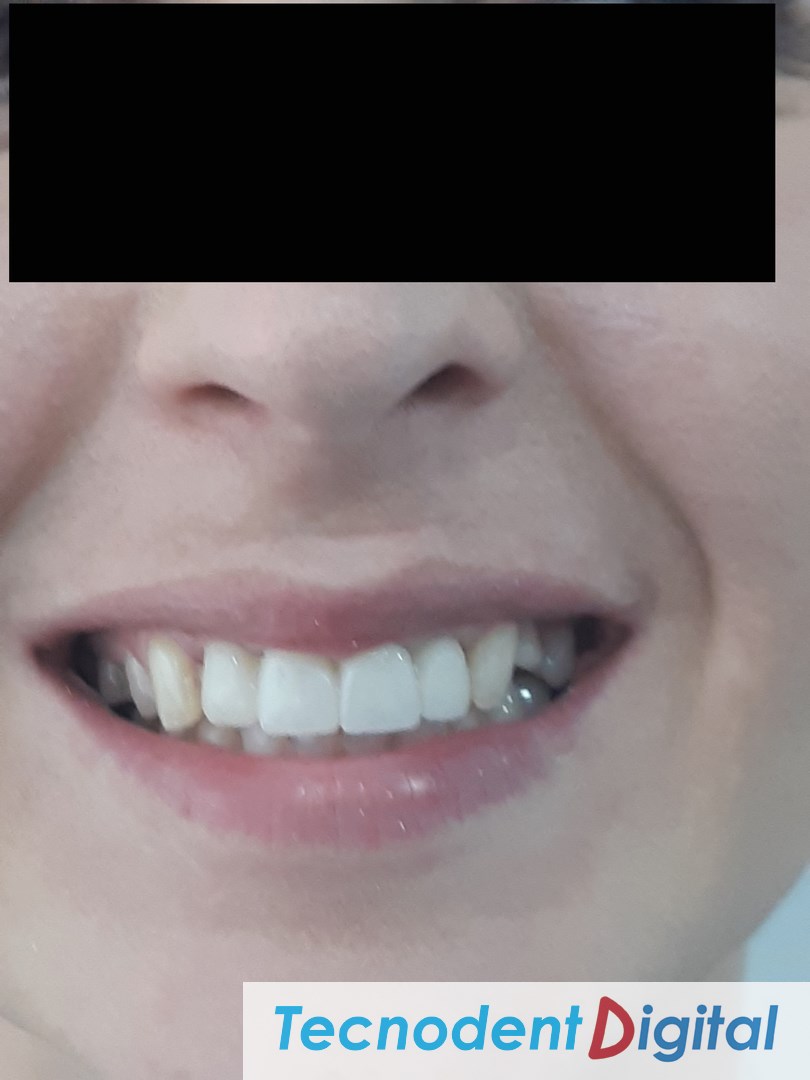 Zirconia Fused to Metal. Laboratorio Dental Gandia. Centro de Fresado. Odontologia Estetica.