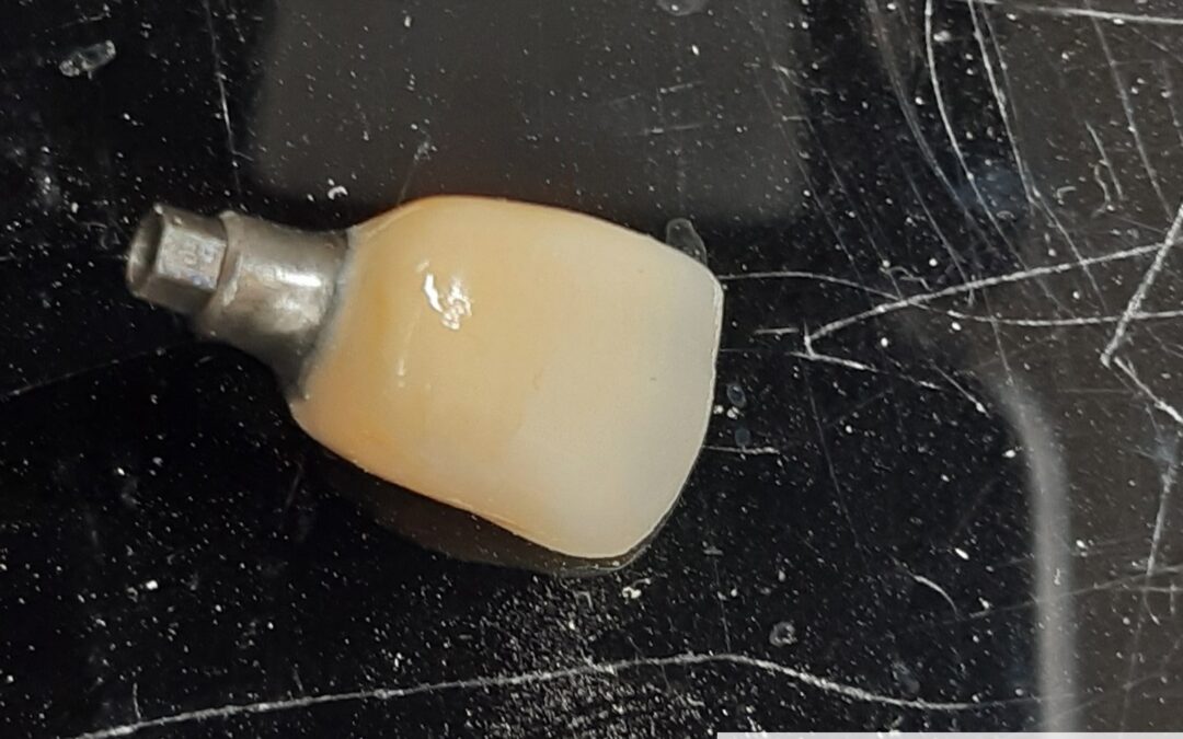 ZFM-Zirconia-Fused-to-Metal-Laboratorio-DentalGandia-Odontologia-Estetica-Centro-de-Fresado