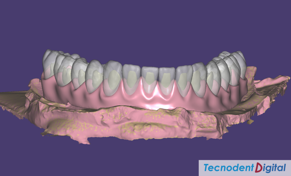 Rehabilitacion Implantes Arco gotico laboratorio Dental Gandia Estetica Dental