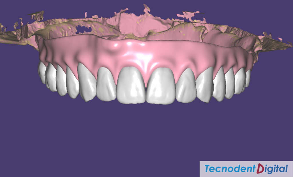 Rehabilitacion Implantes Arco gotico laboratorio Dental Gandia Estetica Dental