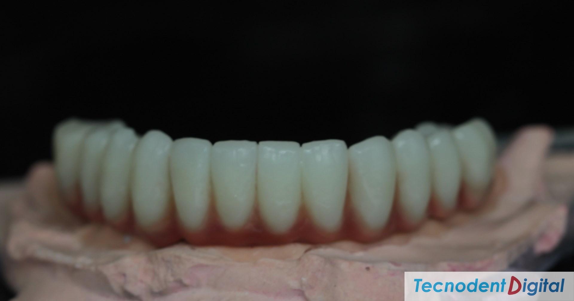 Rehabilitacion Implantes Arco gotico laboratorio Dental Gandia Estetica Dental